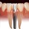 IMPLANTES DENTALES EN GUAYAQUIL