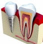 IMPLANTES DENTALES