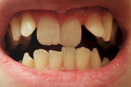 MALA POSICION DE DIENTES